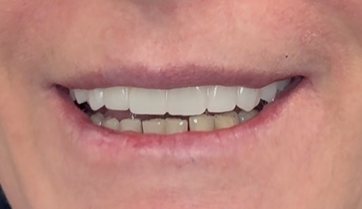 After treatment
