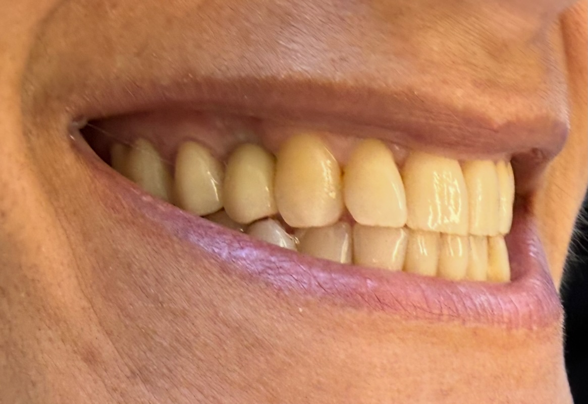 After treatment