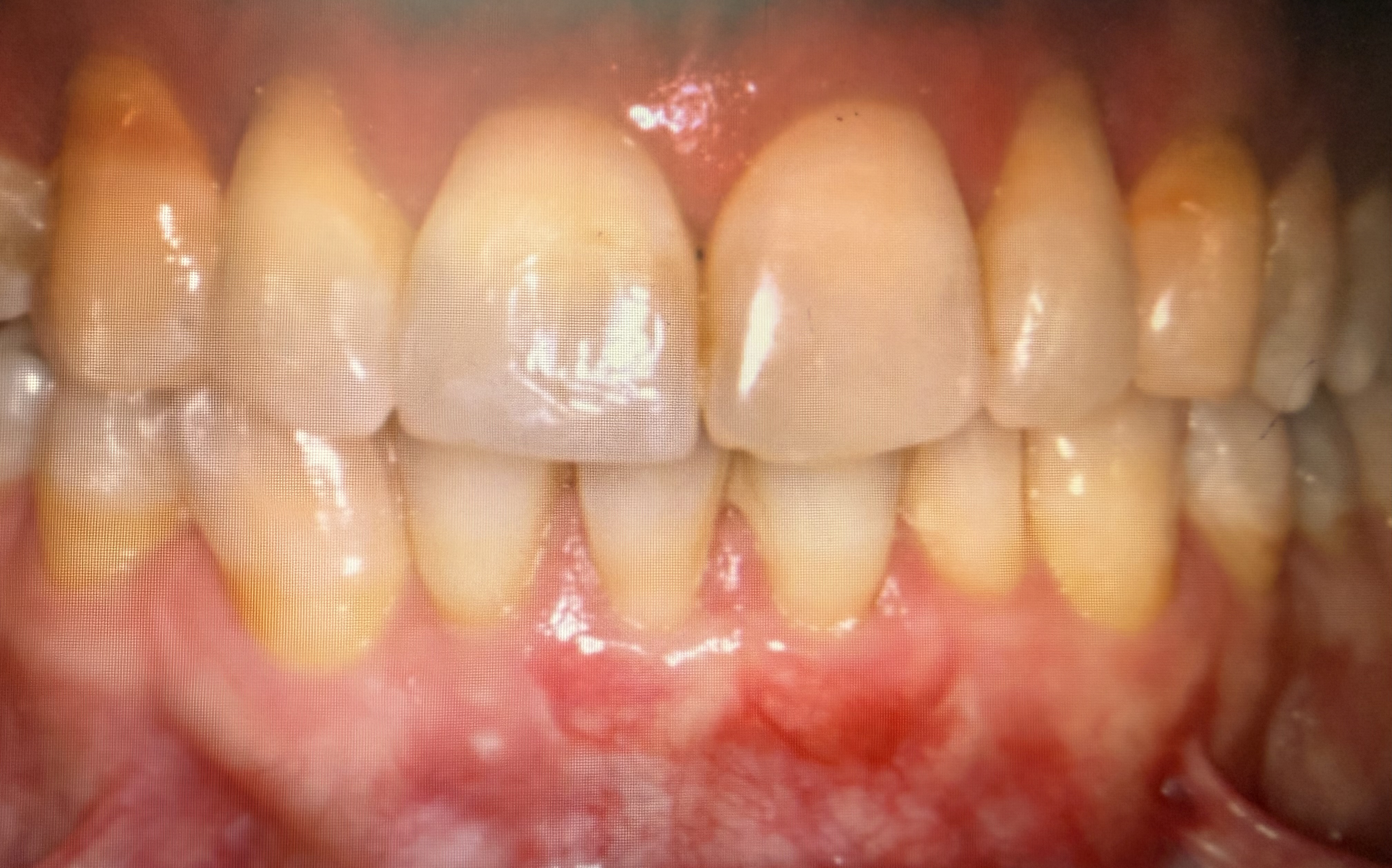After treatment