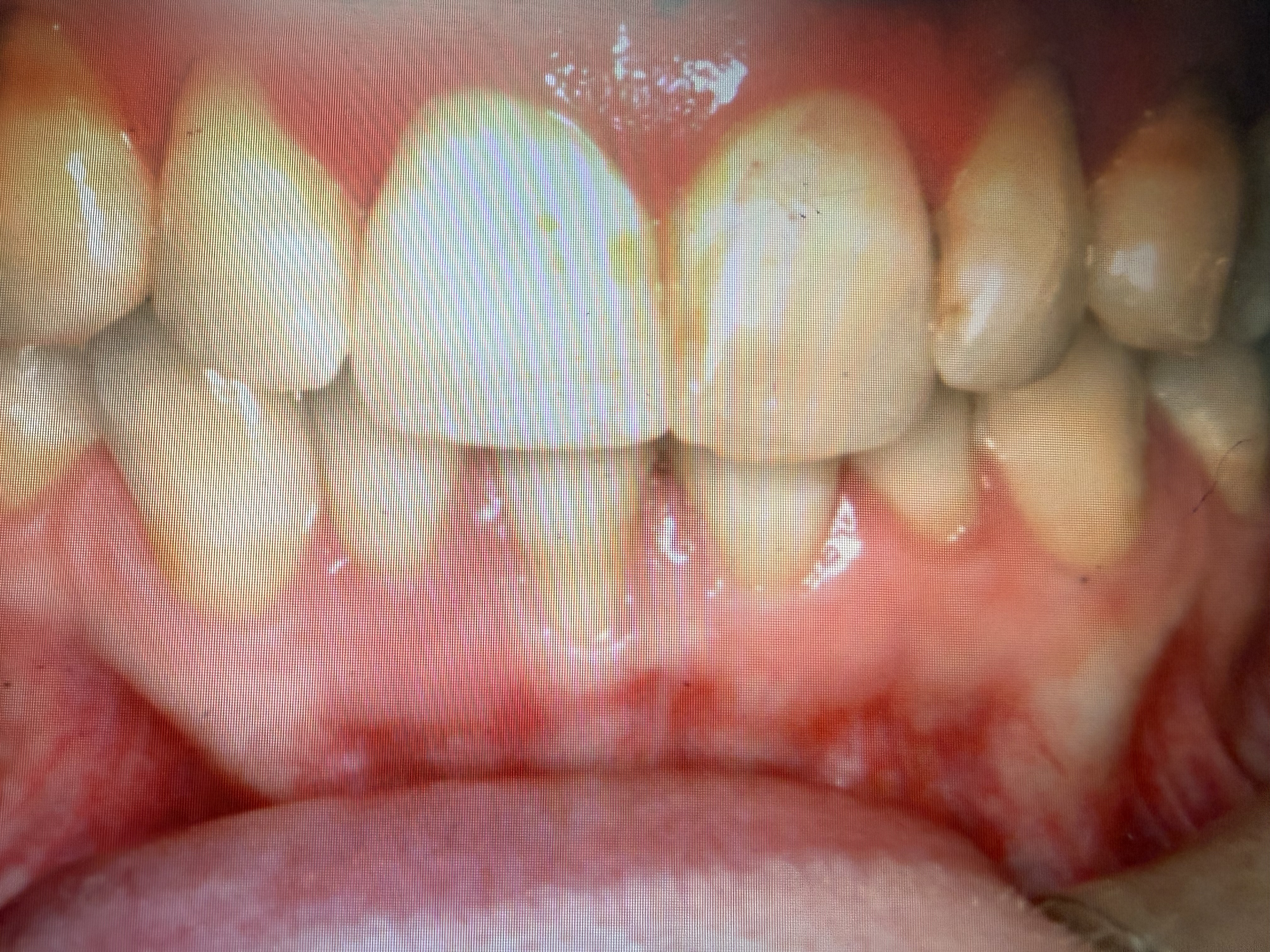 Before treatment
