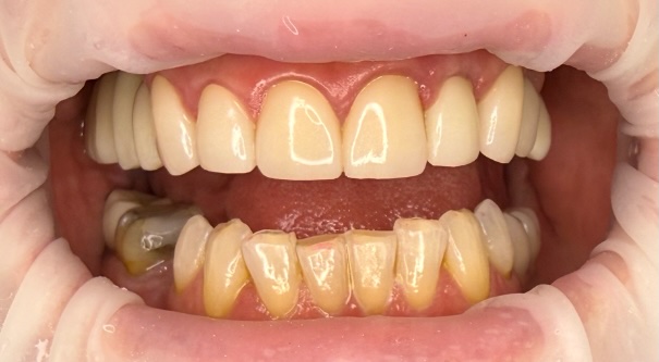 After treatment