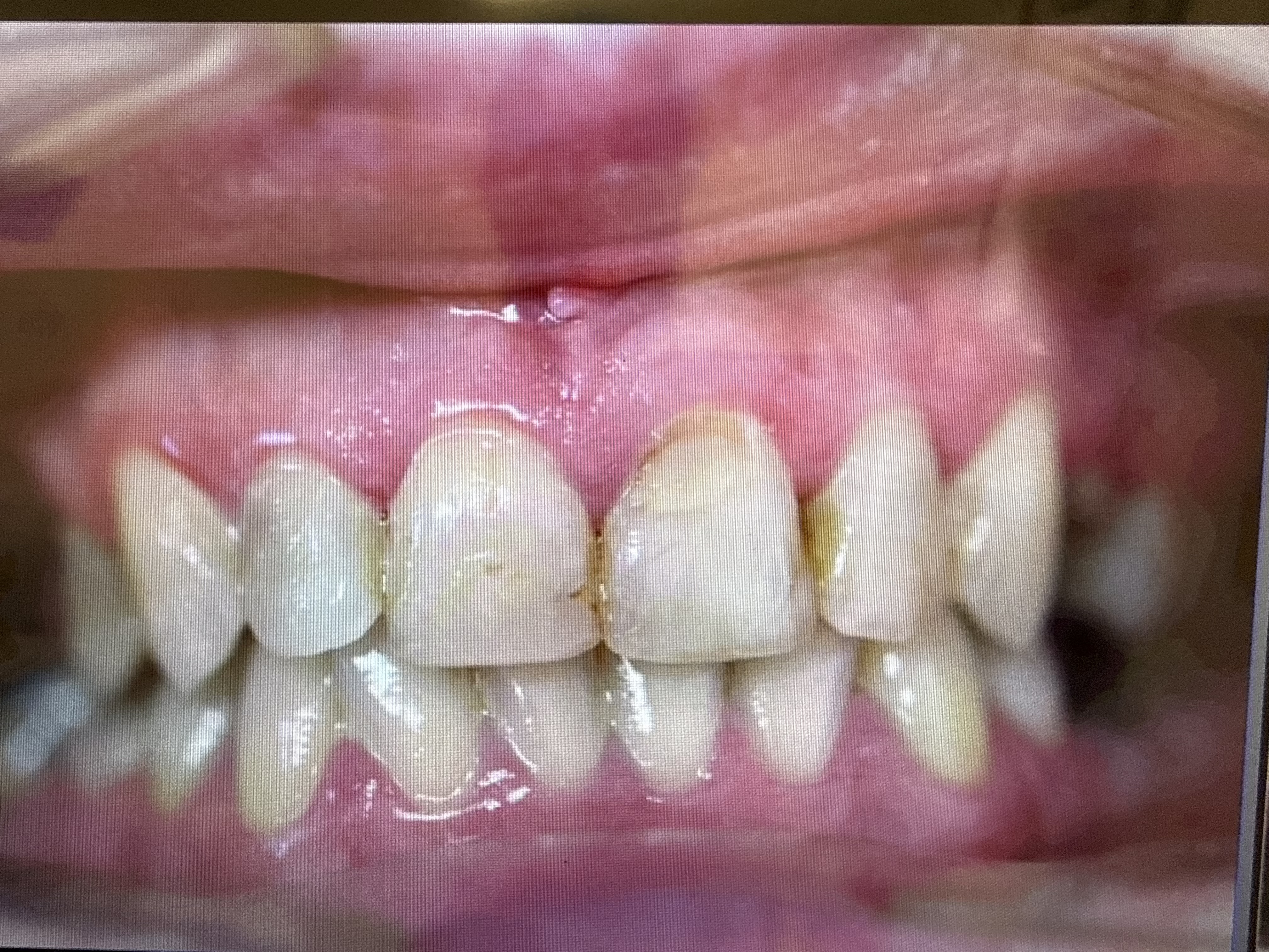 Before treatment